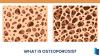 Osteoporosis